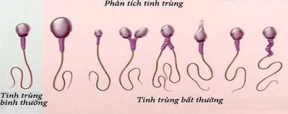 Thiểu năng tinh trùng là gì? Có thụ tinh nhân tạo được không?