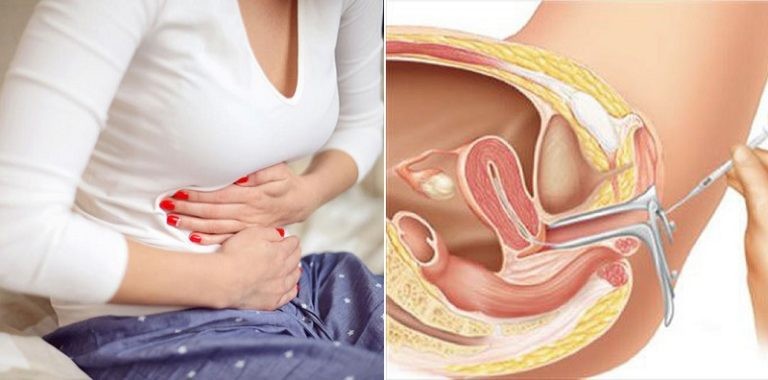 Tổng hợp 5 ảnh hưởng khi thụ tinh nhân tạo bằng phương pháp iui