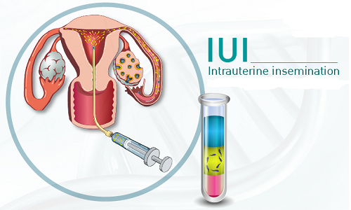 IUI bơm tinh trùng vào tử cung thụ tinh nhân tạo - phương pháp mới 2020