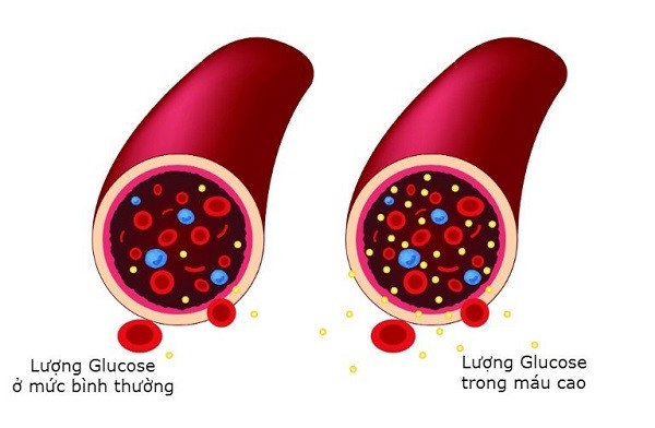 Đường huyết lên xuống thất thường cùng những điều cần chú ý
